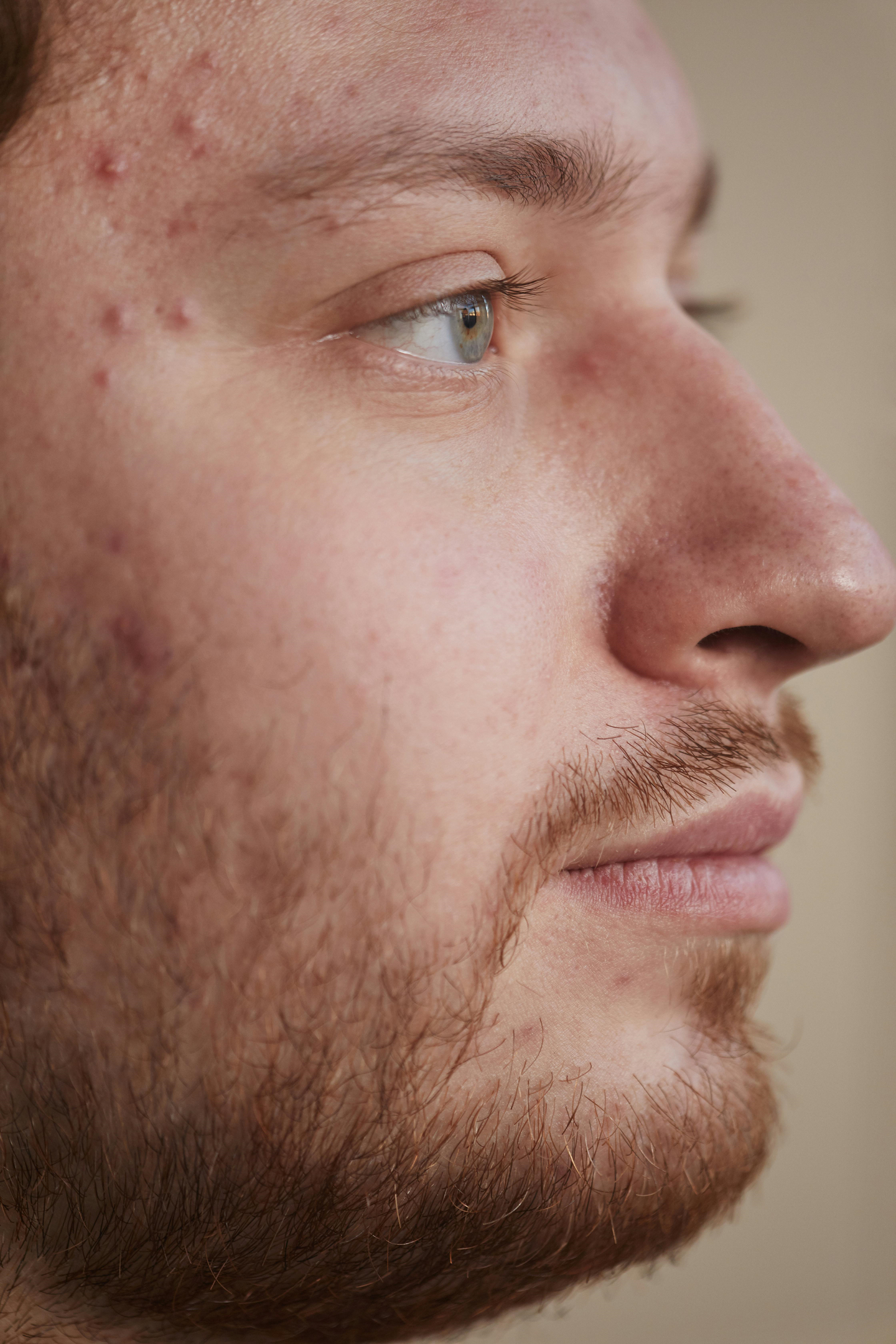 Acne in Your 20s: Demystifying the Breakouts and Finding Your Path to Clearer Skin